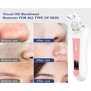 Blackhead Remover Vacuum Wifi 5.0Mp Visual Facial Pore Cleanser Pimple Sucker 1080P Hd 20X Microscope Camera Removal